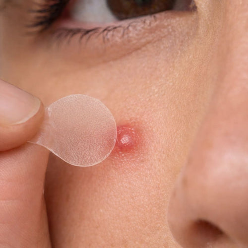 Acne Patches