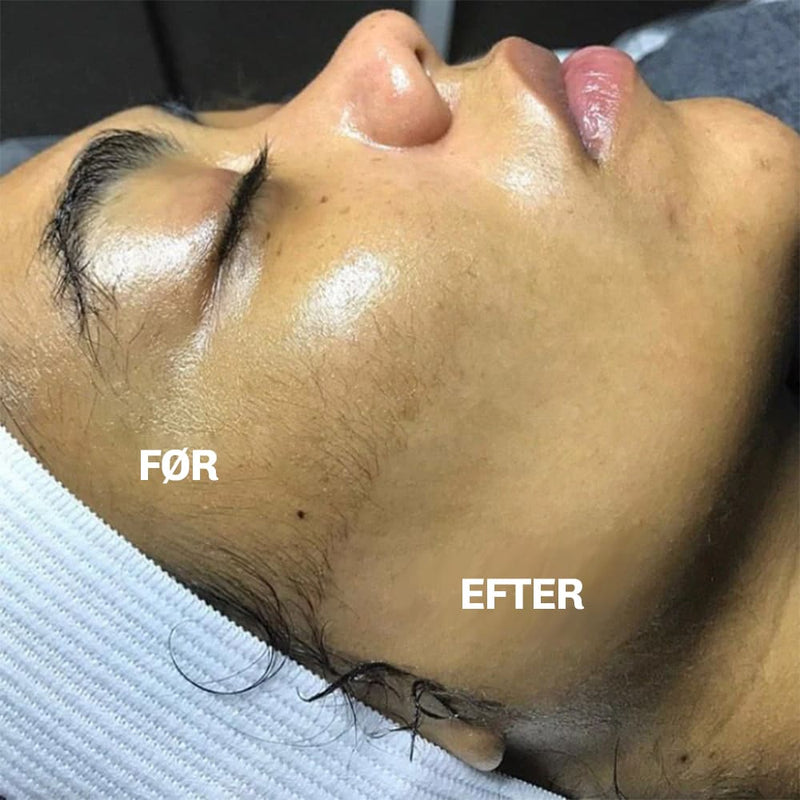 Skansom dermaplaning behandling til glat og stralende hud derhjemme