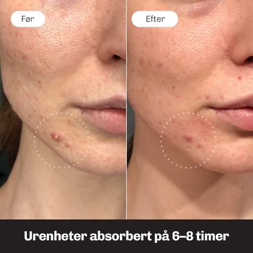 Anti pickel patches der reducerer urenheder over tid