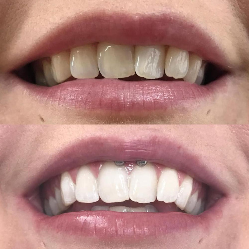 Whitening Mundskyl iD+